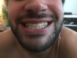 Teeth Whitening, She Might Be